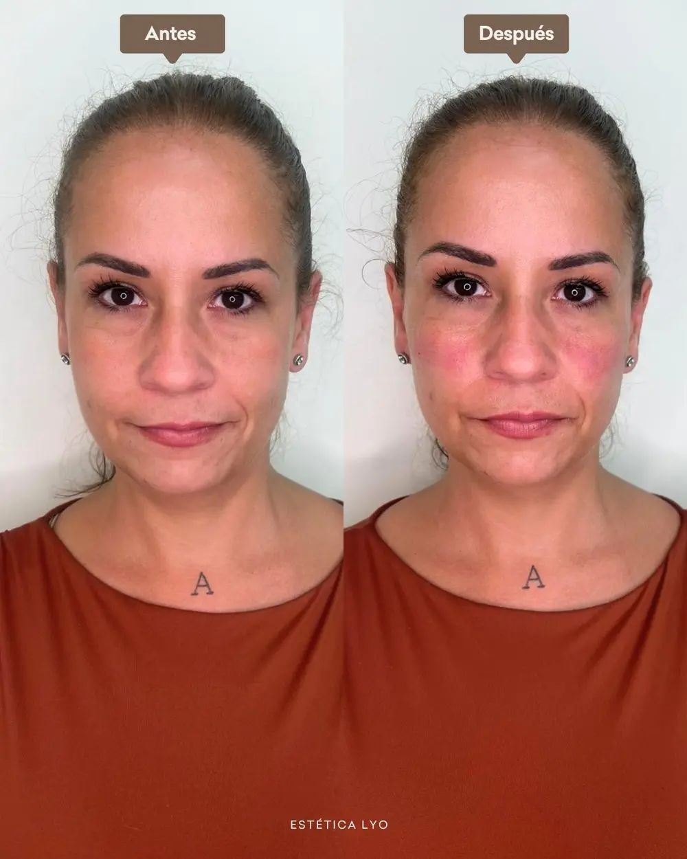 Antes y después: Soporte malar